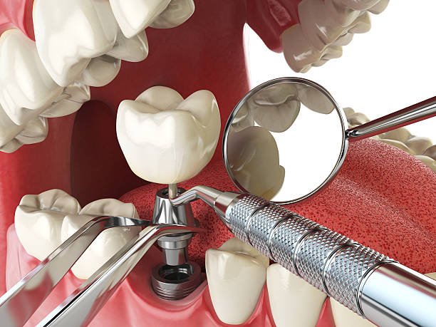 Best Emergency Root Canal Treatment in Navy, VA